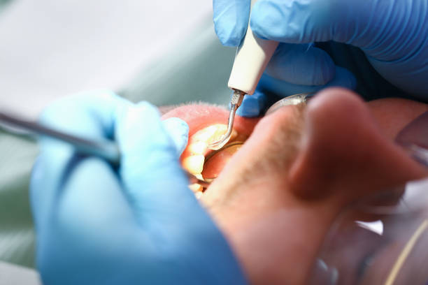 Emergency Dental Filling Replacement in IL